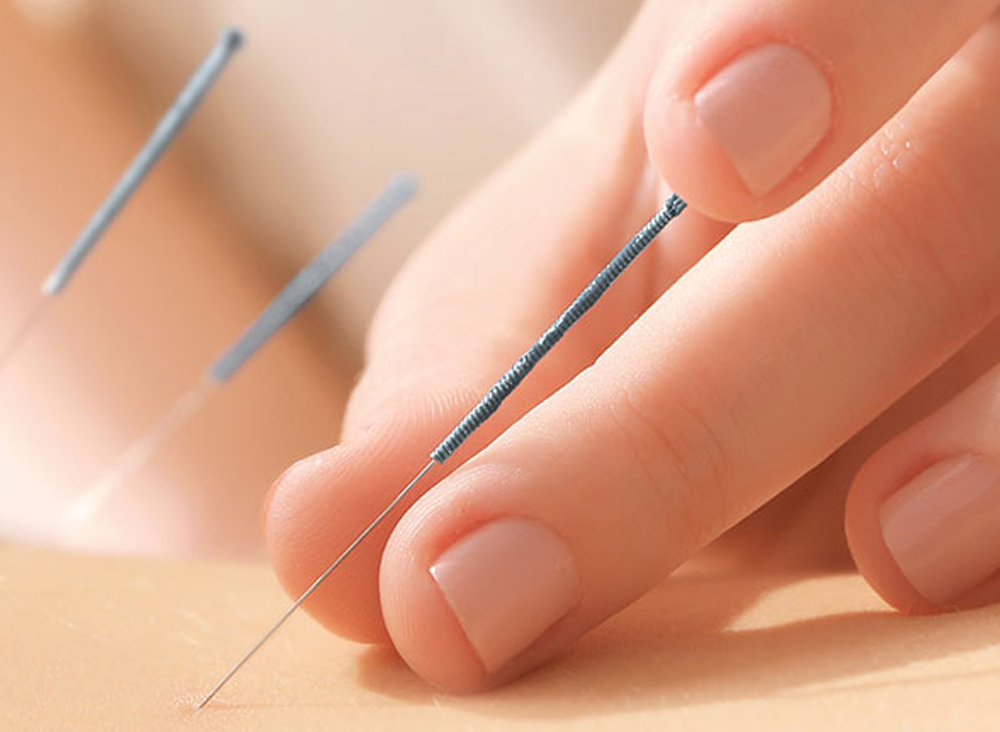 Acupuncture @ Pranava